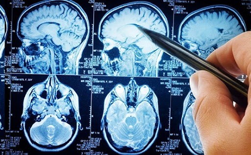 بیماری های مغز و اعصاب از آلزایمر تا هماتوم