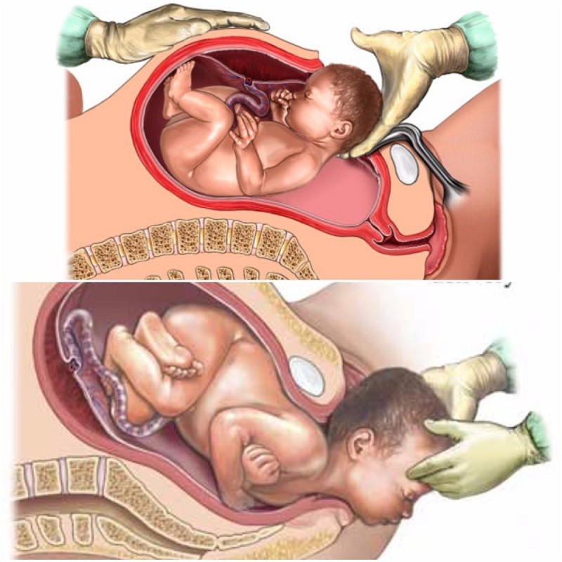 مقایسه زایمان طبیعی و سزارین